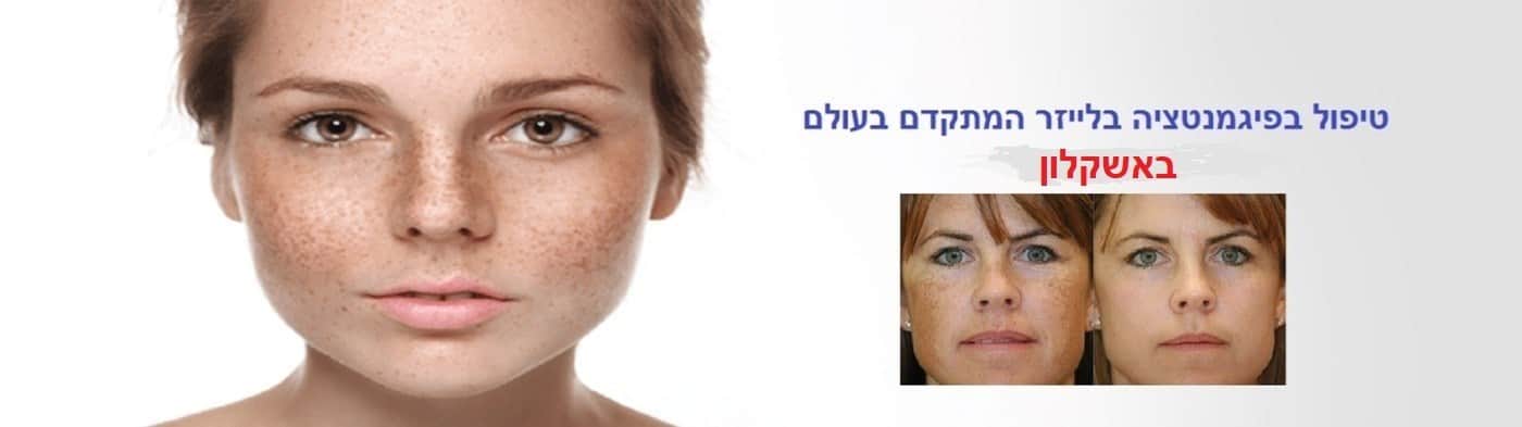 טיפול בפיגמנטציה באשקלון