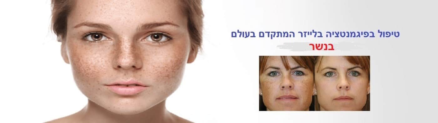 טיפול בפיגמנטציה בלייזר בנשר
