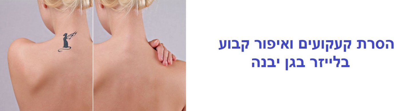 הסרת קעקועים בלייזר בגן יבנה | הסרת קעקוע בלייזר בגן יבנה