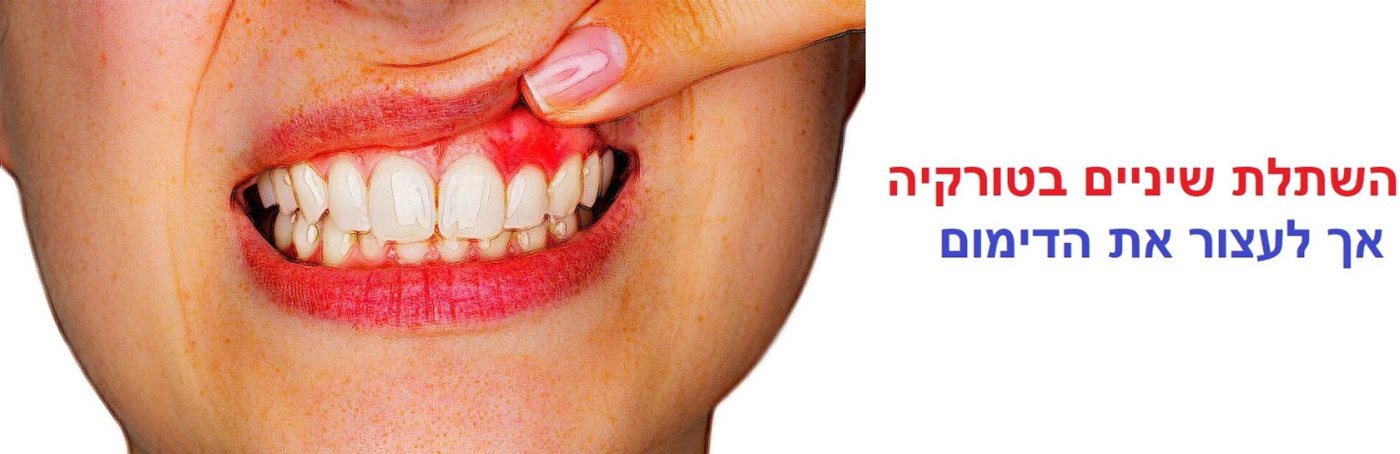 השתלת שיניים בטורקיה - אך לעצור את הדימום