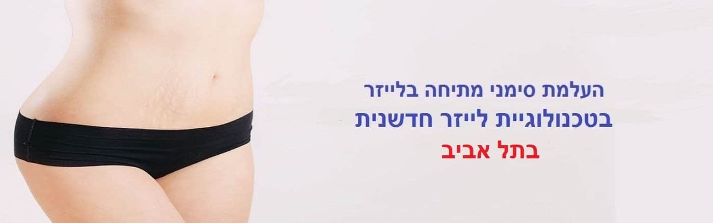 העלמת סימני מתיחה בתל אביב