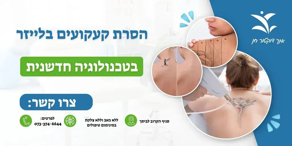 הסרת קעקועים