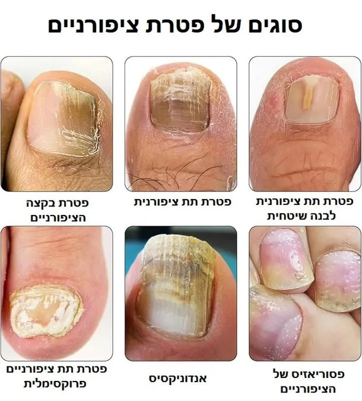 סוגים של פטרת ציפורניים - תמונות