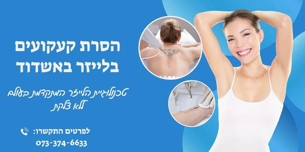 הסרת קעקועים באשדוד