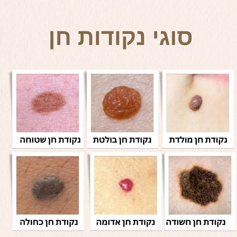 סוגי נקודות חן - מעודכן תאריך: 02/09/2025