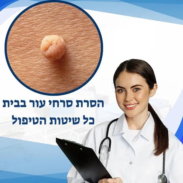 הסרת סרחי עור בבית