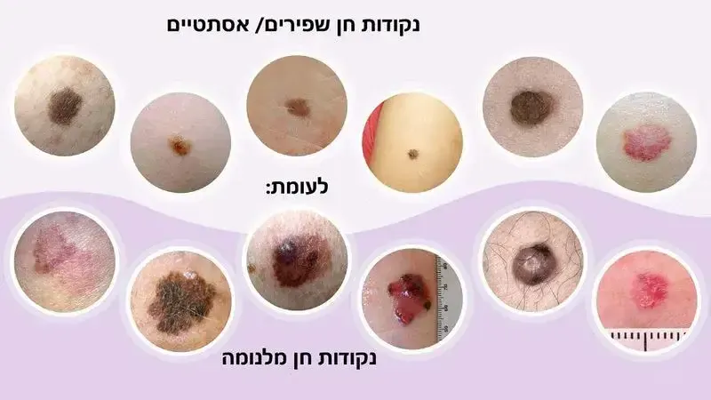 תמונות נקודות חשודות מלנומה מול נקודות חן שפירים