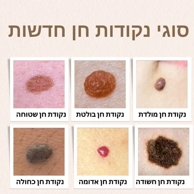 סוגי נקודות חן חדשות