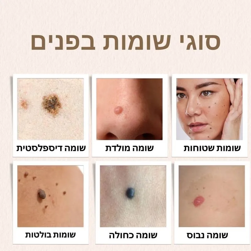 סוגי שומות בפנים