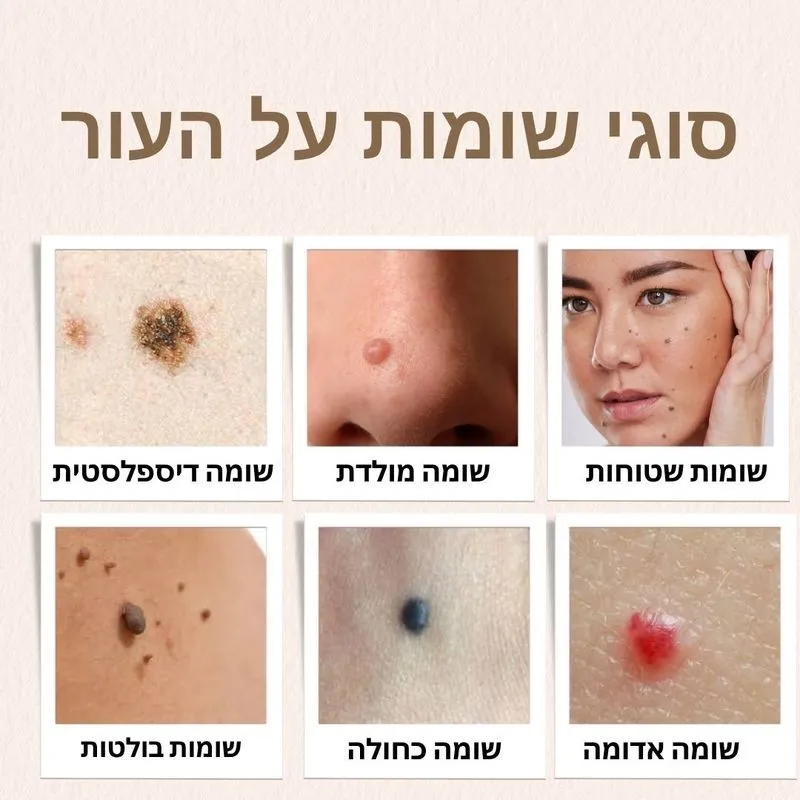 סוגי שומות על העור