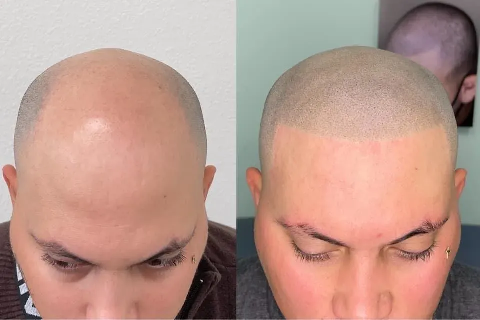 הדמיית שיער לפני ואחרי