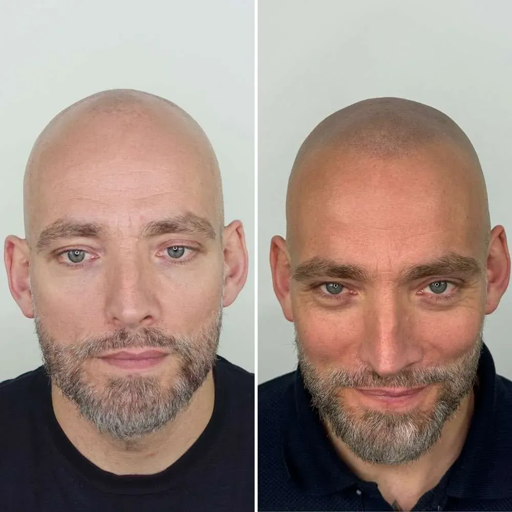 הדמיית שיער לפני ואחרי