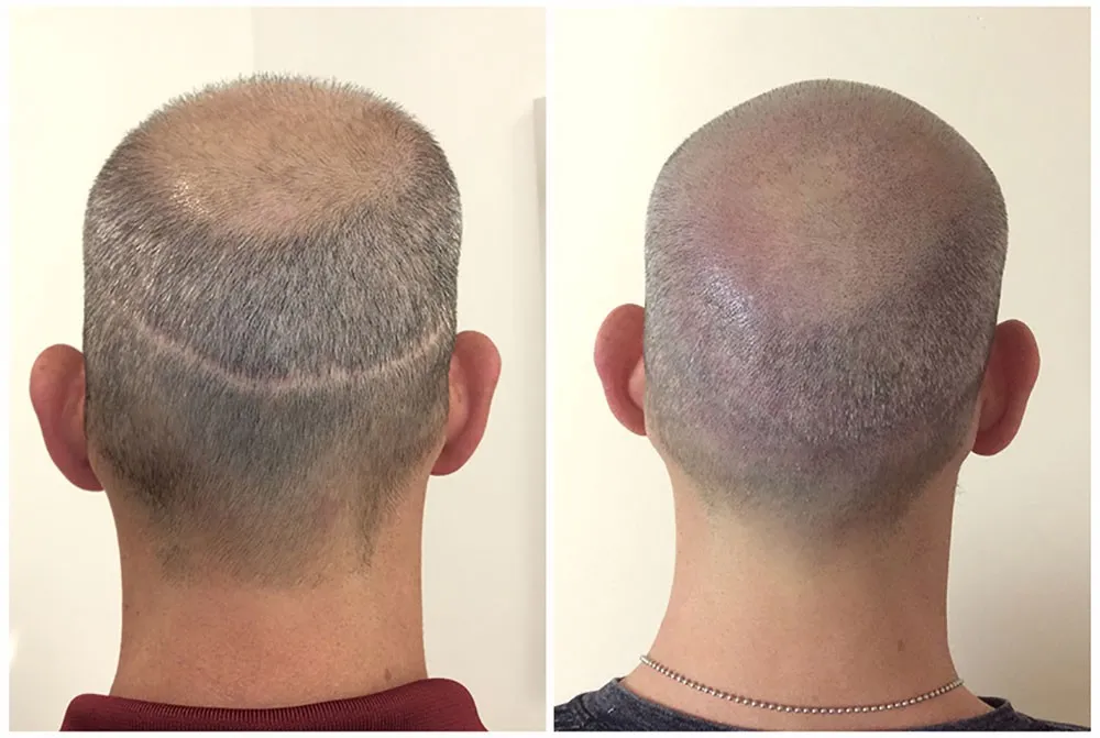 הדמיית שיער לצלקות לאחר השתלת FUT בראש