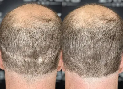 טשטוש צלקות בראש בהדמיית שיער לפני ואחרי