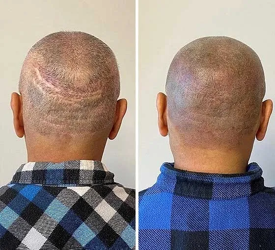 טשטוש צלקות בראש בהדמיית שיער לפני ואחרי