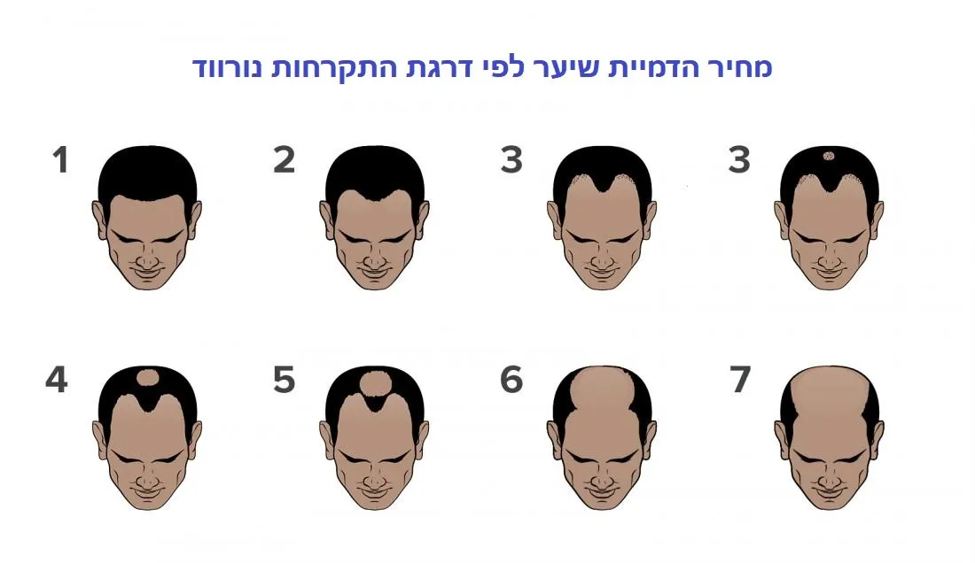 מחיר הדמית שיער לפי דרגת התקרחות נרווד