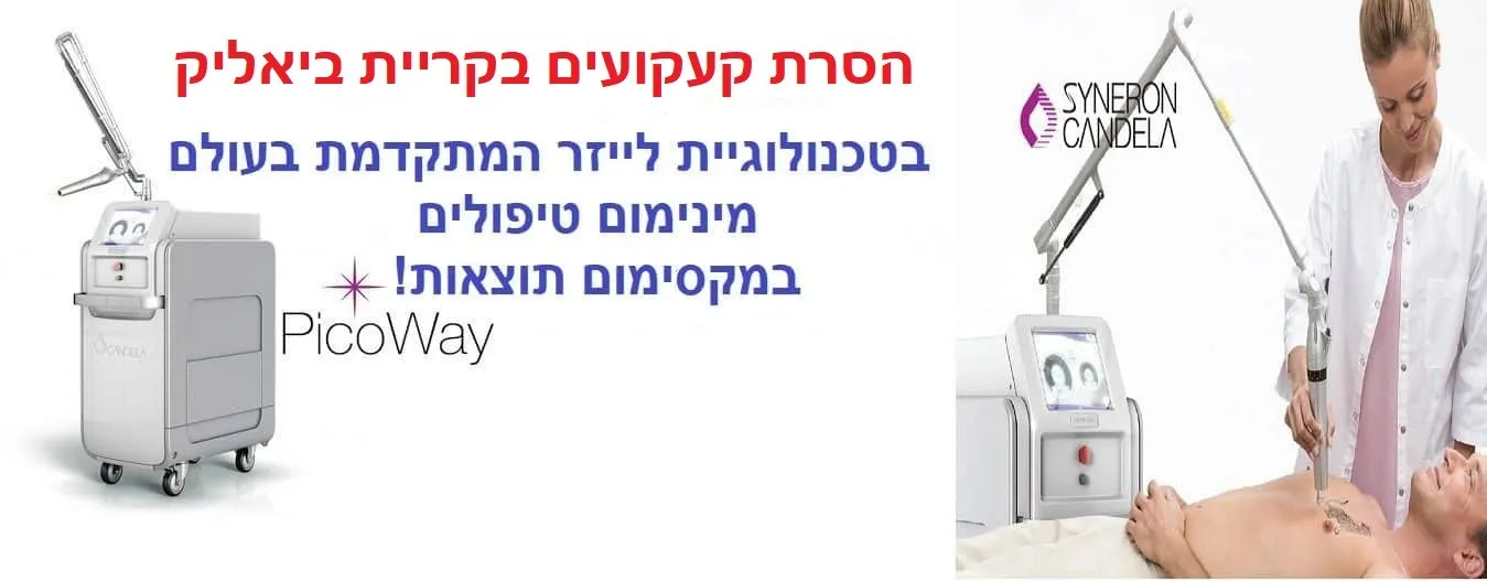 הסרת קעקועים בלייזר בקריית ביאליק
