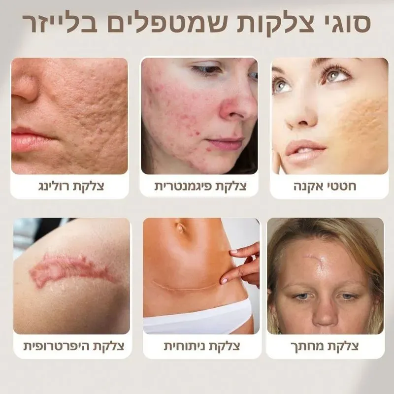 הסרת צלקות - מעודכן תאריך: 14/12/2025