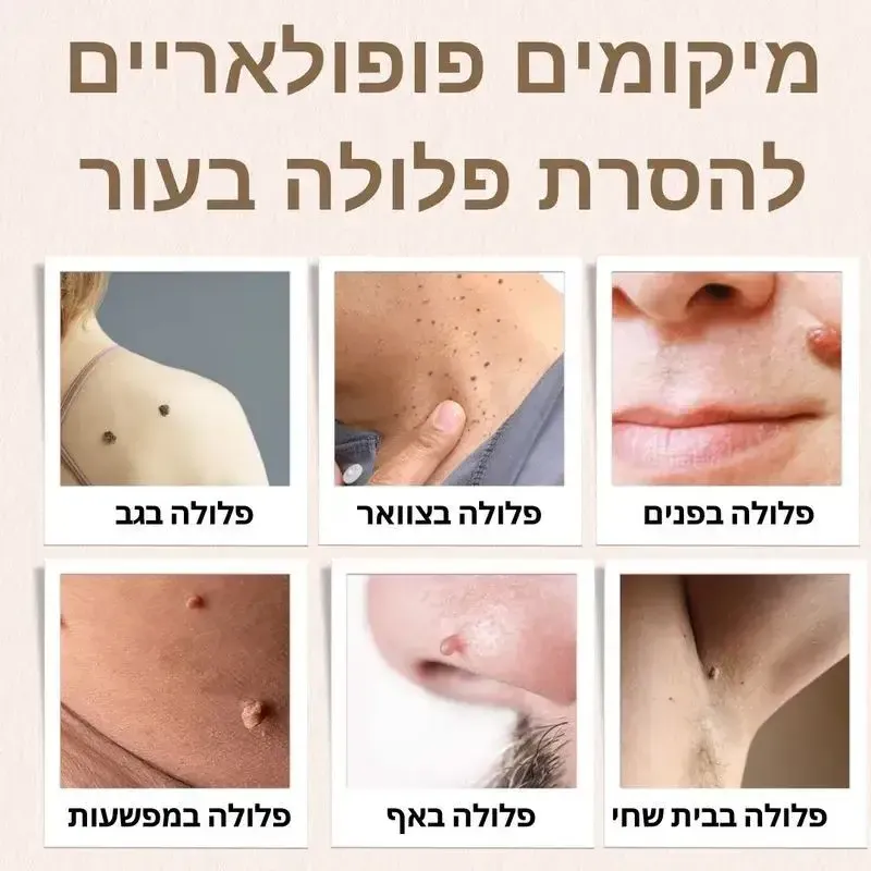 הסרת פלולות - בכל אזור בגוף