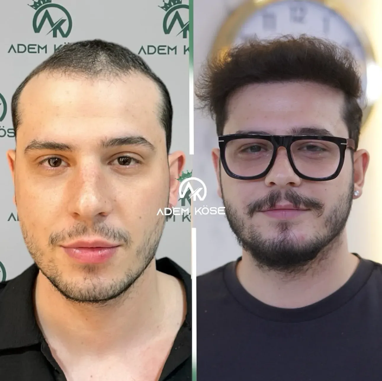 השתלת שיער בגאורגיה - לפני ואחרי