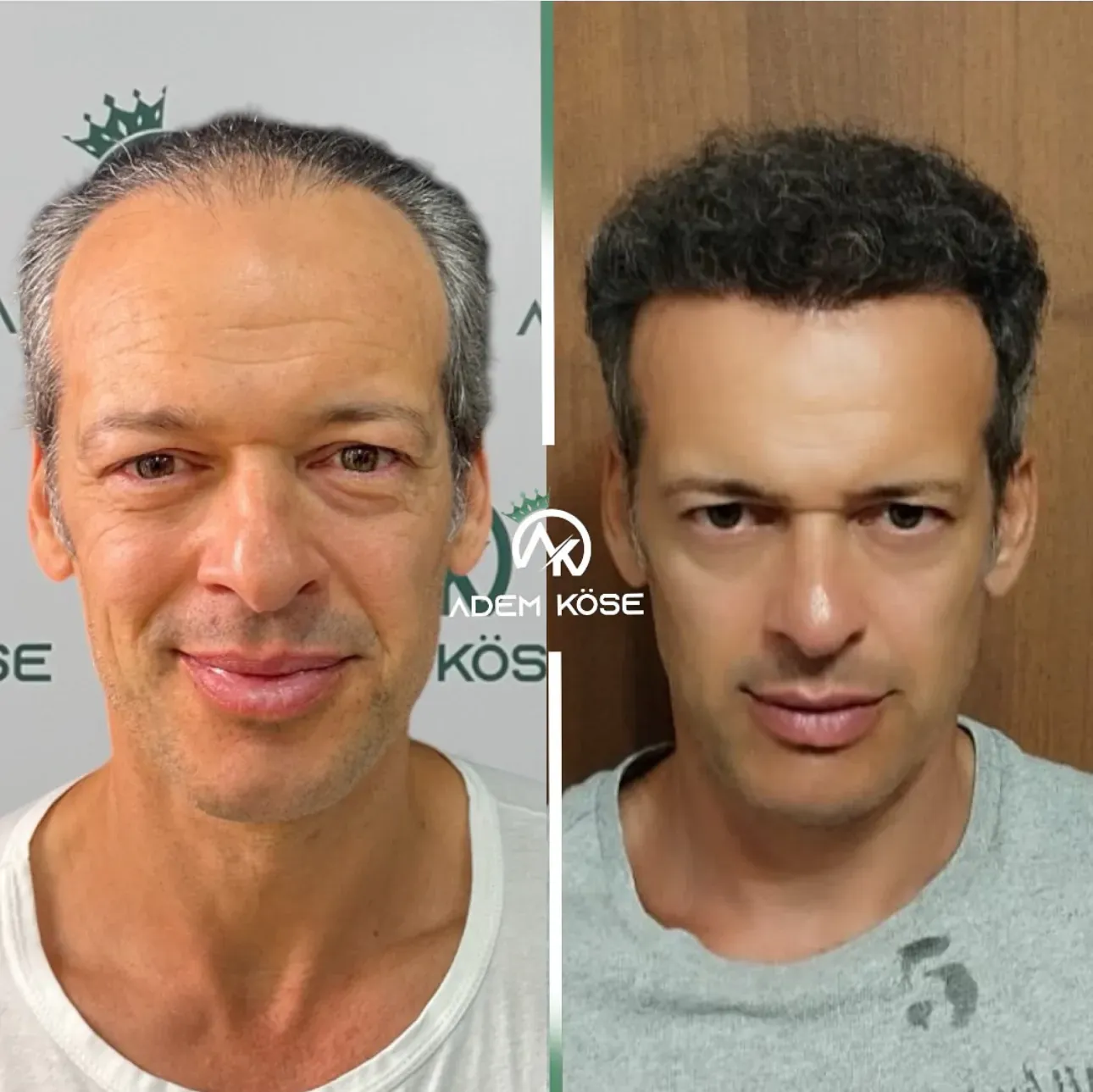 השתלת שיער בגאורגיה - לפני ואחרי