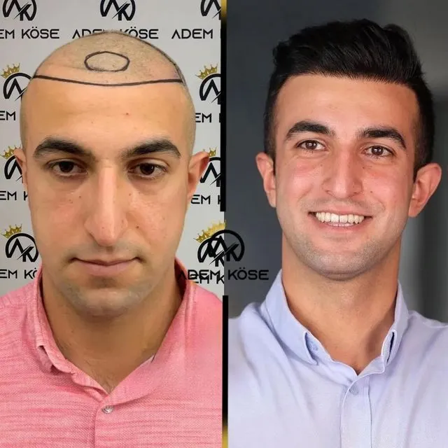 השתלת שיער בגאורגיה - לפני ואחרי