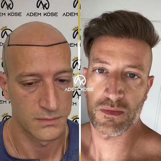 השתלת שיער בגאורגיה - לפני ואחרי