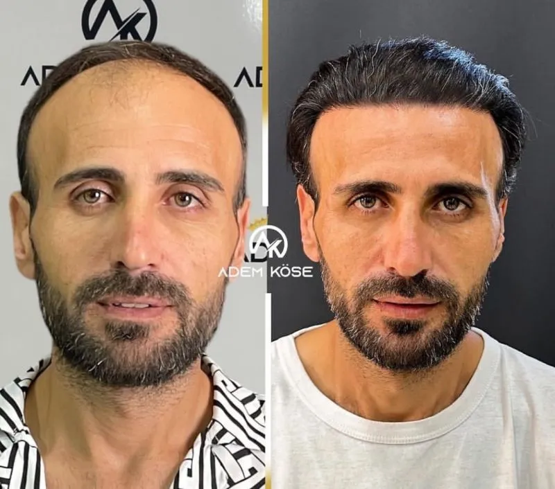 השתלת שיער בגאורגיה - לפני ואחרי