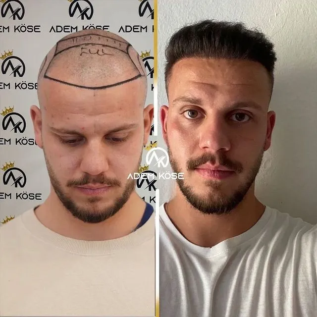 השתלת שיער בגאורגיה - לפני ואחרי