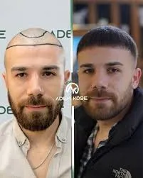 השתלת שיער בגאורגיה - לפני ואחרי