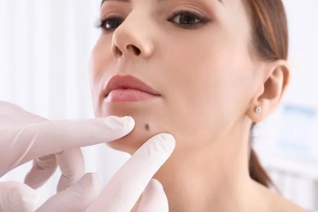 נקודות חן בפנים 