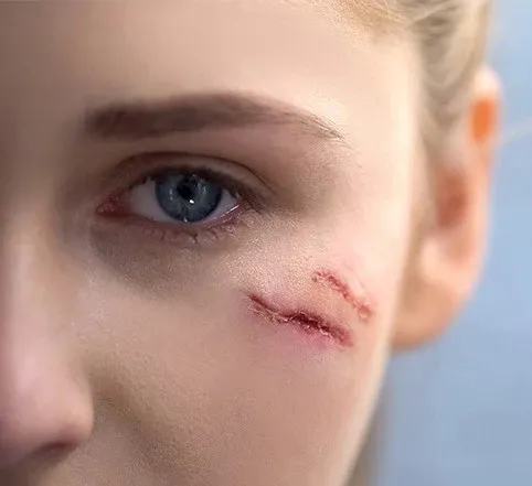 צלקות בפנים