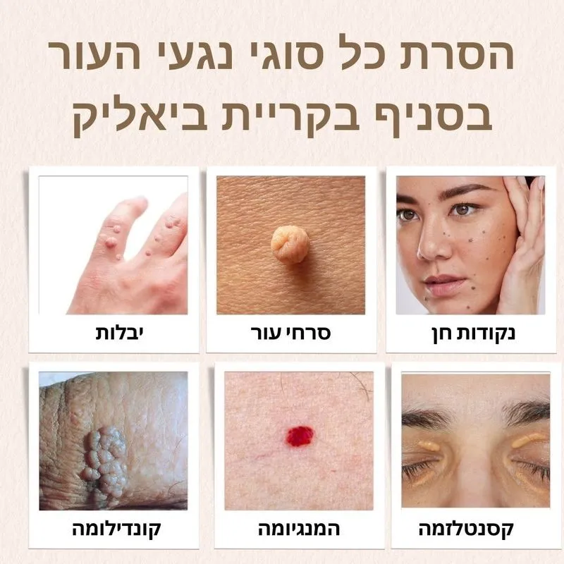 הסרת נגעי עור בקריית ביאליק בצפון