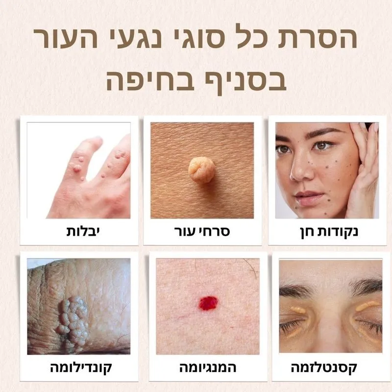 הסרת נגעי עור בחיפה