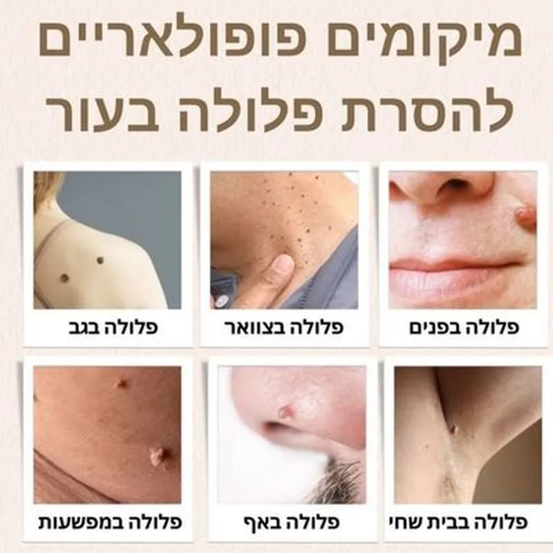 מיקומים פופולאריים להסרת פלולות