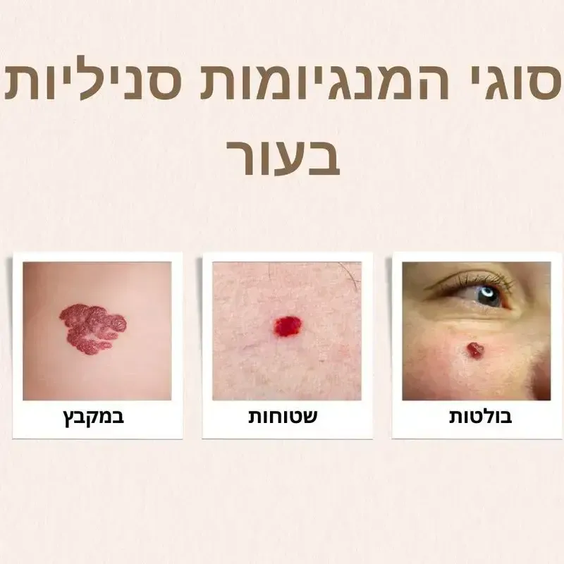 הסרת המנגיומות בגדרה