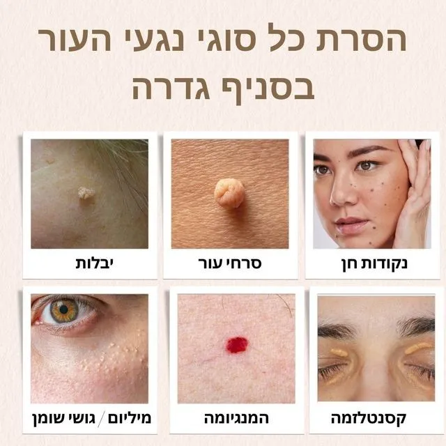 סוגי הסרת נגעי עור בגדרה