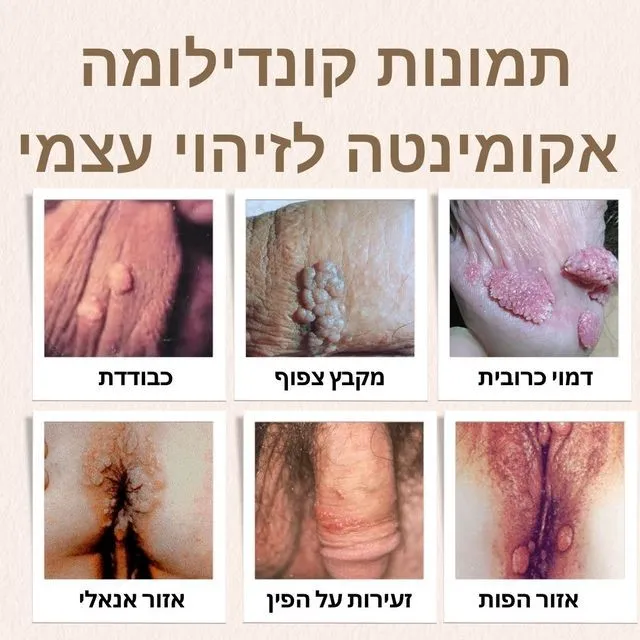 תמונות קונדילומה אקומינטה