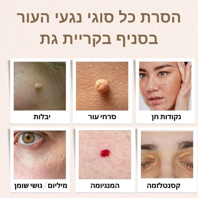 הסרת נגעי עור בקריית גת