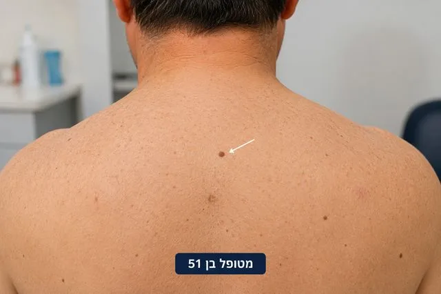נגע חשוד בגב בבדיקה הקליניקת