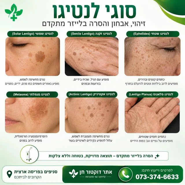 סוגי לנטיגו בעור