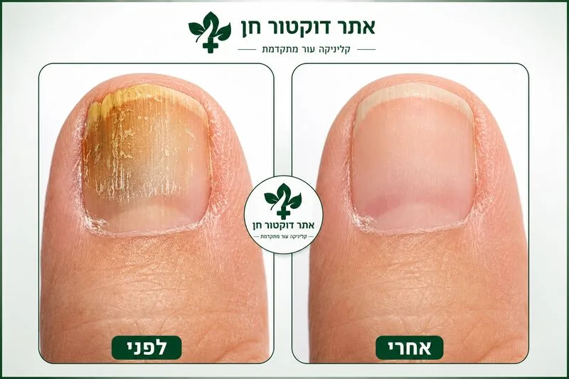 טיפול בפטרת ציפורניים בלייזר - לפני ואחרי