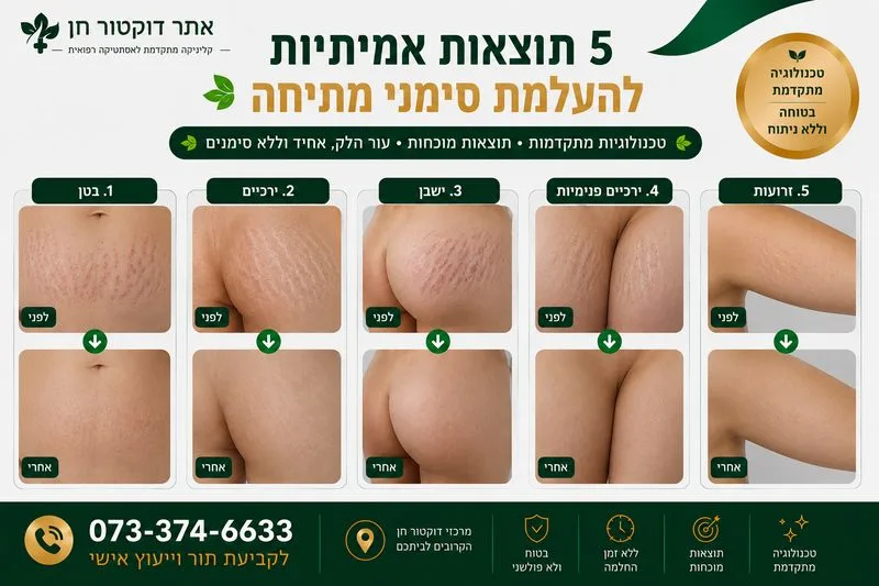 העלמת סימני מתיחה לפני ואחרי