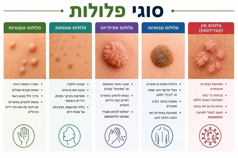 סוגי פלולות