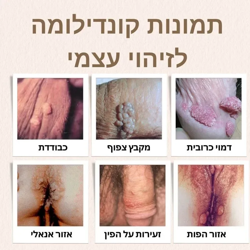 לפניכם תמונות להמחשת המראה האופייני של קונדילומה ולסיוע בזיהוי ראשוני של הנגעים.