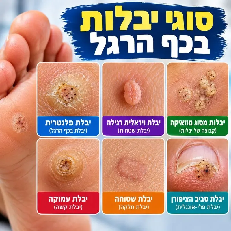 סוגי יבלות בכף הרגל תמונות