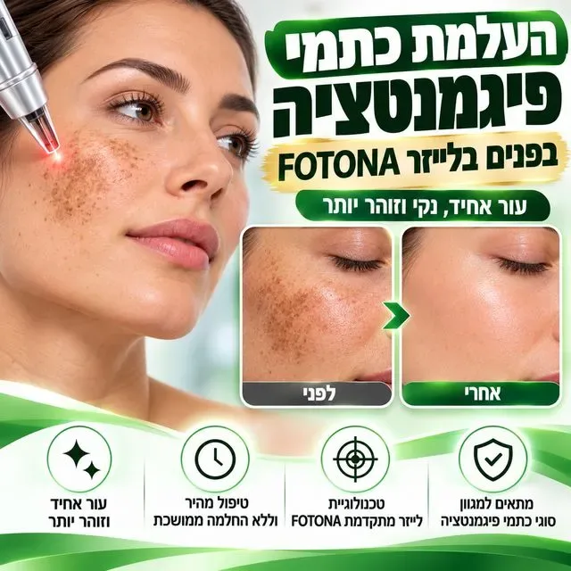 העלמת כתמי פיגמנטציה בפנים בחיפה