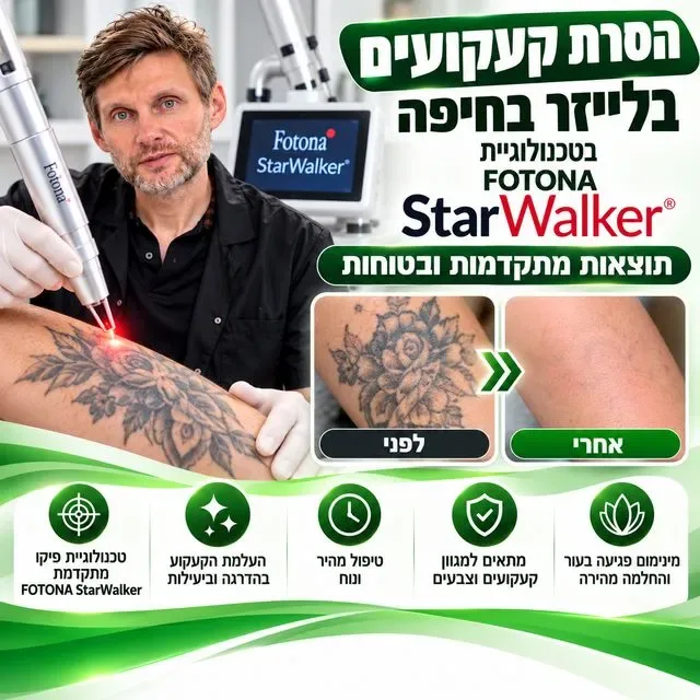הסרת קעקועים בלייזר בחיפה