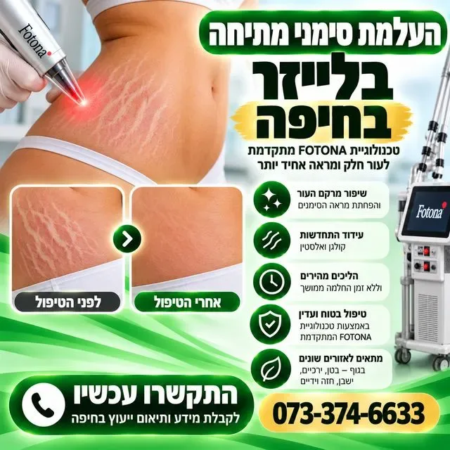 העלמת סימני מתיחה בלייזר בחיפה