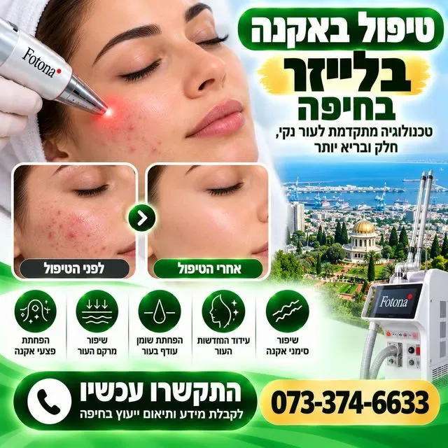 טיפול באקנה בלייזר בחיפה